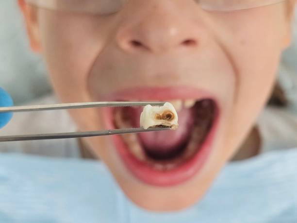 Best Emergency Wisdom Teeth Removal in Morton, PA